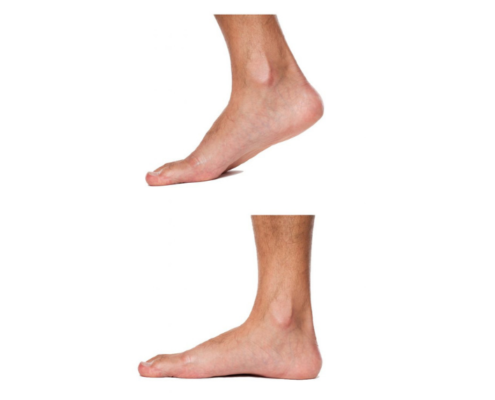 Flat Feet Treatment Huntington Beach - OC Advanced Foot Care